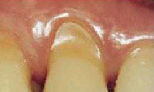 Повышенная чувствительность зубов: причины и лечение