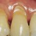 Повышенная чувствительность зубов: причины и лечение